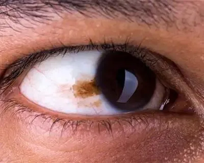 A macro, close-up image of a human iris showing a small, distinct brown spot, representing an eye freckle or nevus.